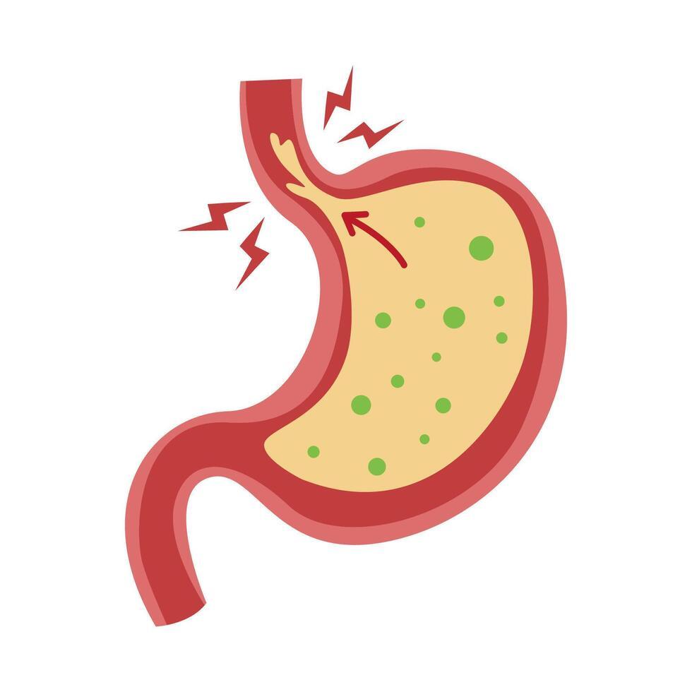 Acid Reflux & Heartburn